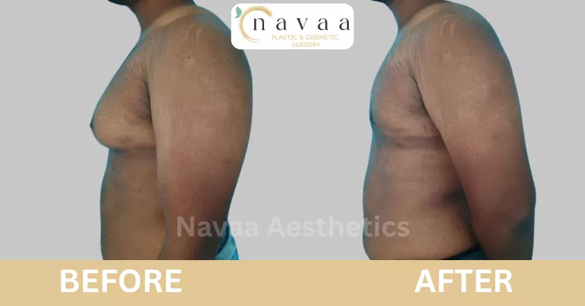Grade 2 gynecomastia surgery before after