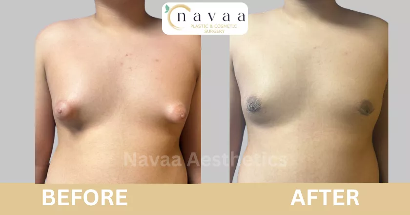 puffy nipple gynecomastia surgery before after