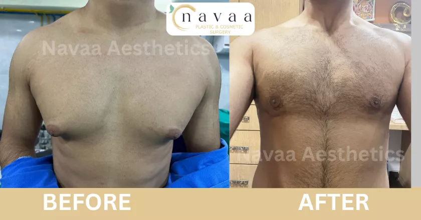 Puffy nipple gynecomastia surgery before after