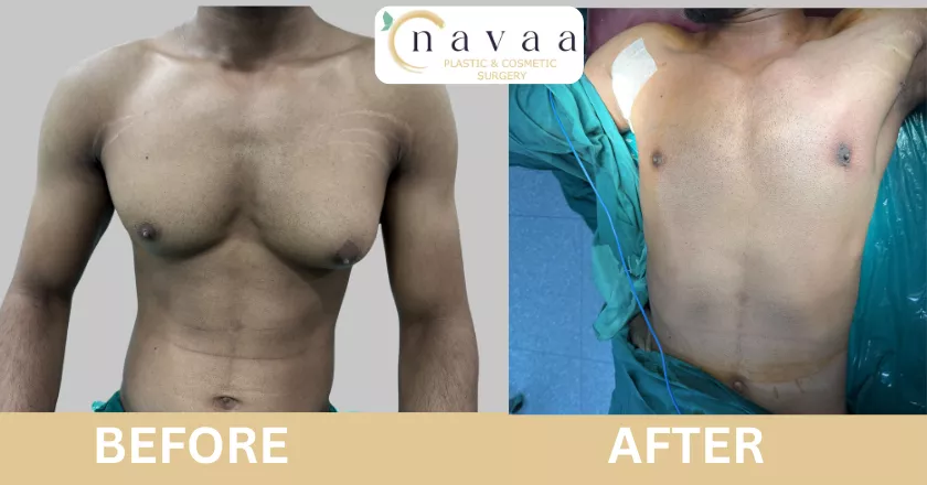 man boobs surgery before after