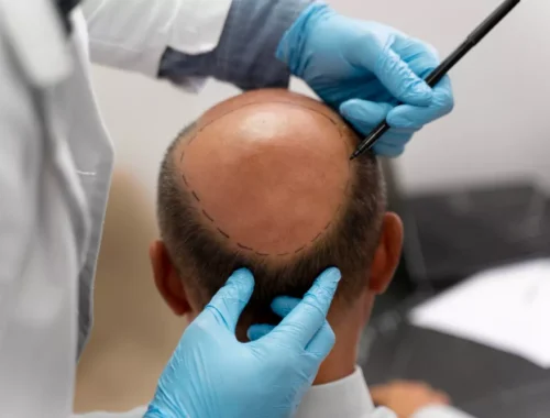 advanced-hair-restoration-69d0ae67252b4