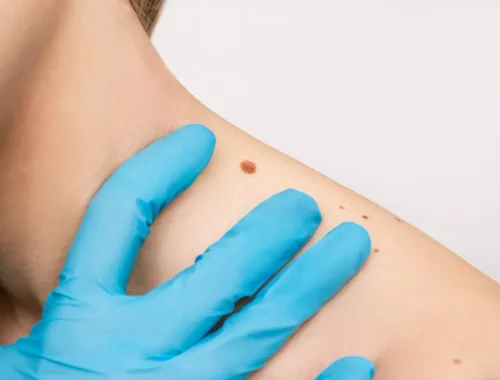 advanced-keloid-removal-69d0ae67f19d9