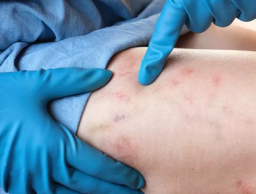 advanced-scar-treatment-69d0ae6822952