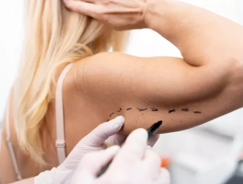 arm-liposuction-arm-lift-69d0ae641b985