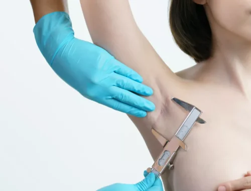 axillary-breast-tissue-removal-69d0ae6406ec5