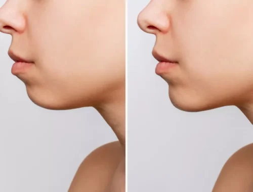 buccal-fat-removal-69d0ae7083c56