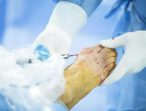 diabetic-foot-surgery-69d0ae6e00d2b