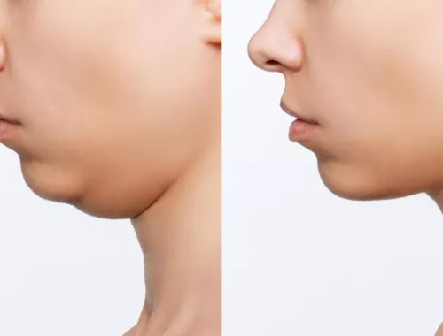double-chin-removal-69d0ae7c24267