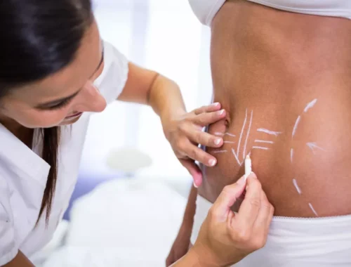 fat-grafting-69d0ae7a846cc