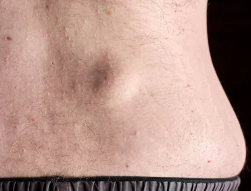 lipoma-removal-69d0ae8c0ead6