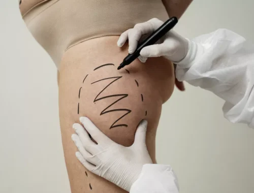 thigh-liposuction-69d0ae94b1d4a