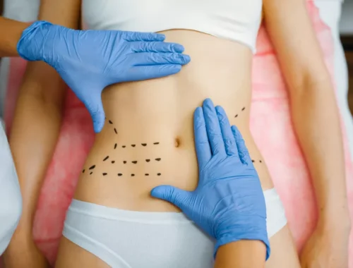 tummy-liposuction-69d0aed0caa91