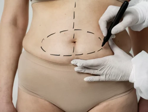 tummy-tuck-69d0aed0d3e7f