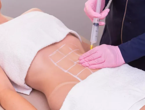 vaser-liposuction-69d0aed1b0f6e