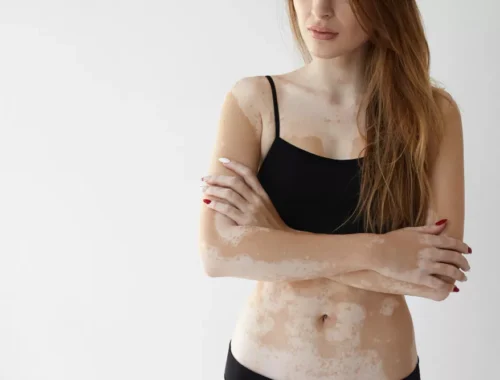 vitiligo-treatment-69d0aed1b64d4
