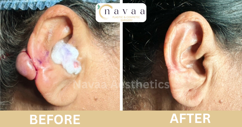ear hole repair