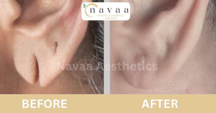 ear hole repair without surgery