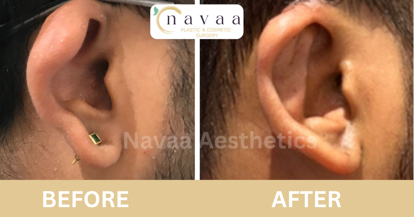 earlobe treatment