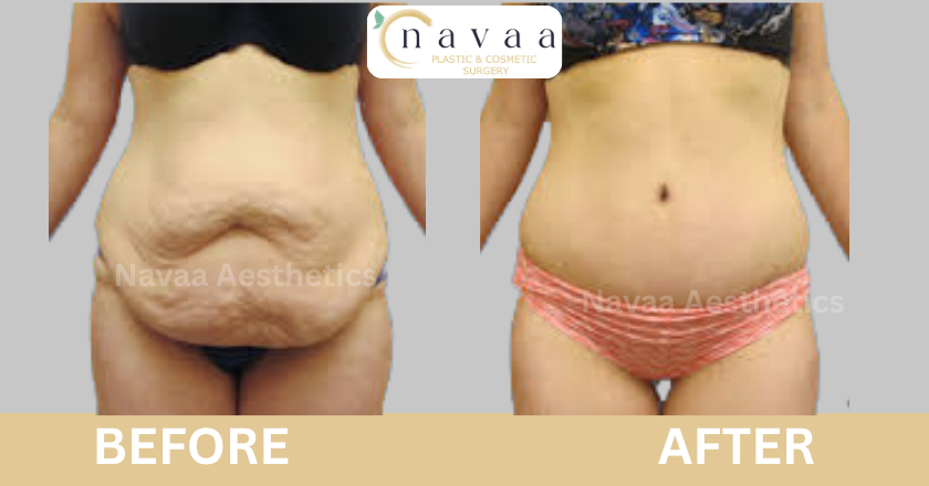 Liposuction (2)