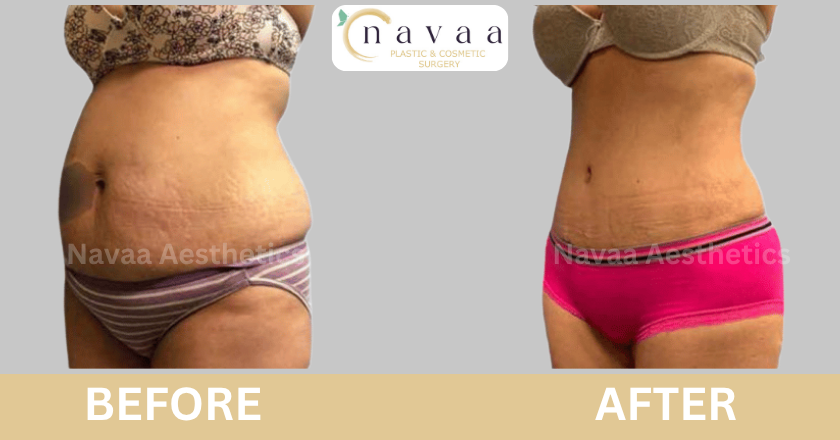 Liposuction (3)