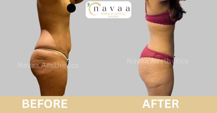 Liposuction (4)
