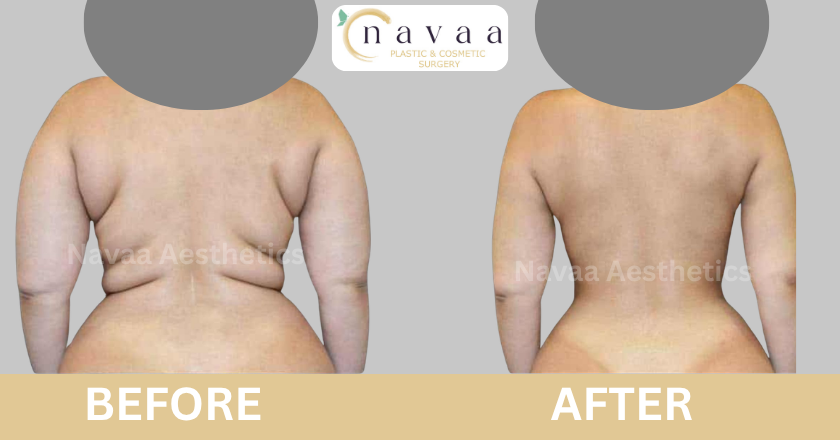 Liposuction (5)