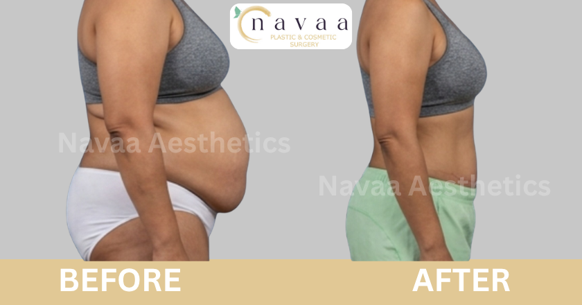 Liposuction