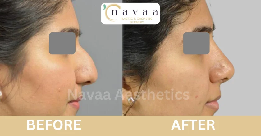 nose surgery