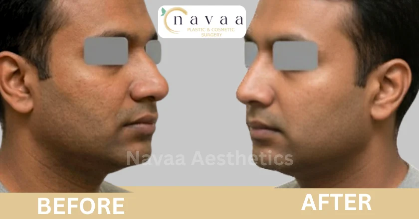 rhinoplasty before and after photos
