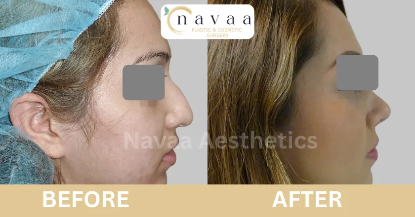 rhinoplasty surgery cost in india