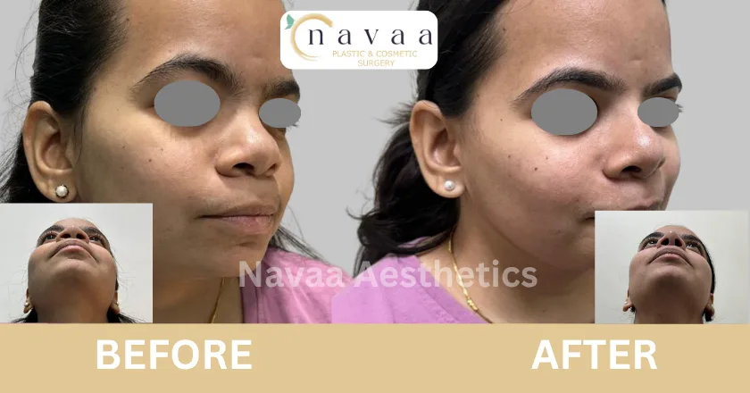 rhinoplasty in mumbai