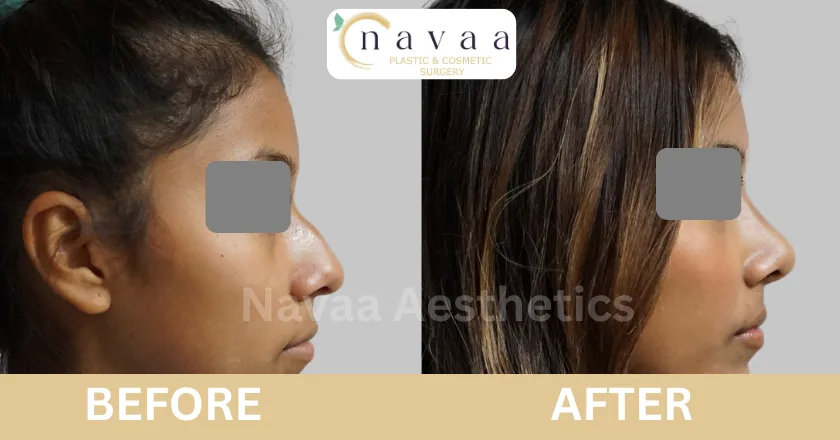 rhinoplasty procedure