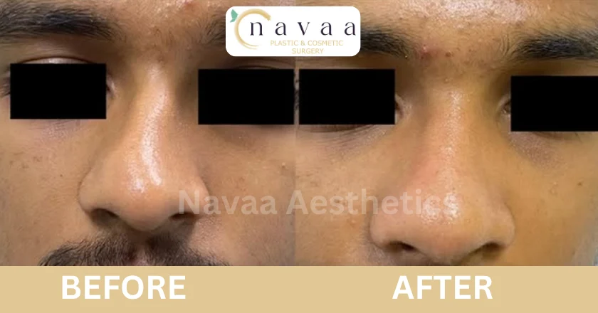 rhinoplasty surgery before and after