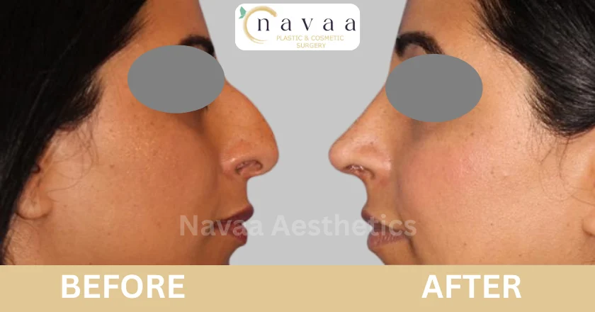 nose straightening surgery