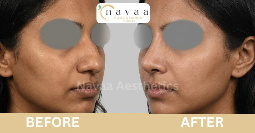 cosmetic rhinoplasty