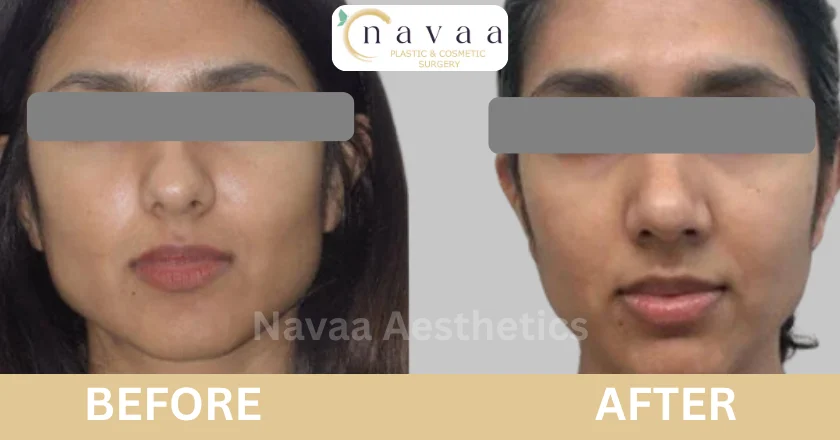 rhinoplasty surgeon in mumbai