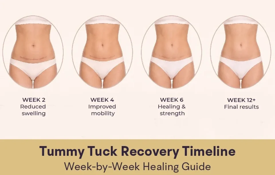 tummy tuck recovery time